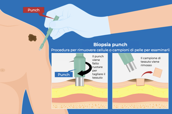 Illustrazione di come funziona il punch utilizzato per la biopsia