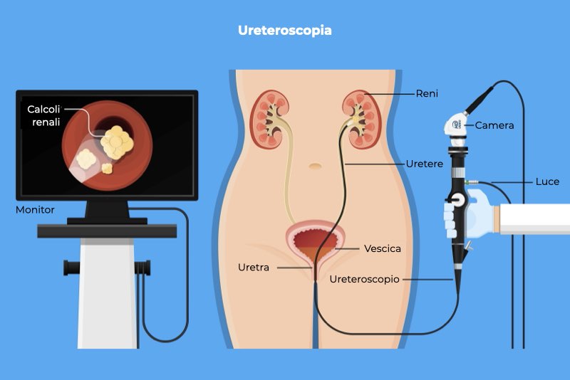 Illustrazione di come viene eseguita una ureteroscopia