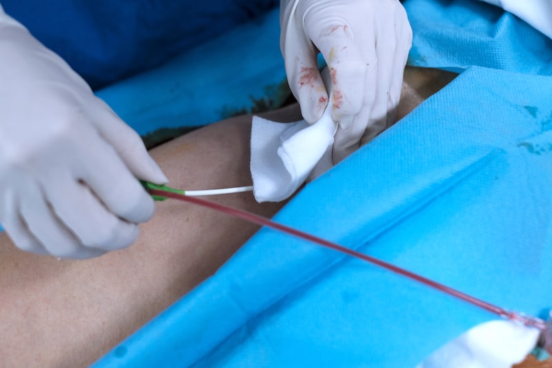 Primo piano del corpo di un paziente in sala operatoria mentre gli viene inserito un catetere attraverso un accesso venoso per eseguire lo studio elettrofisiologico endocavitario