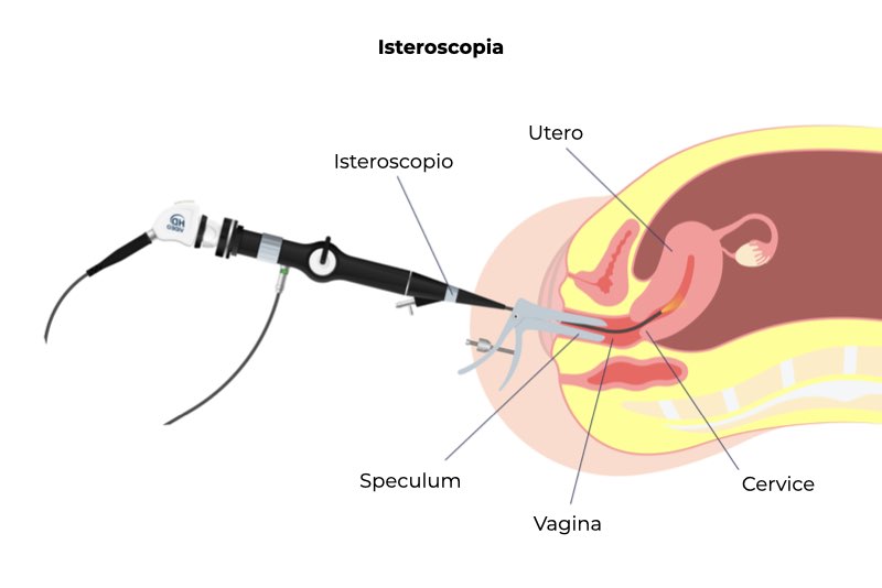 Illustrazione di una vagina e dell'isteroscopio per descrivere come si esegue l'isteroscopia