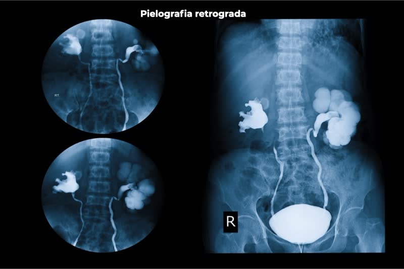 Immagine radiografica eseguita tramite tecnica di pielografia retrograda