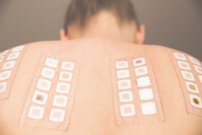 Foto dei tipici cerotti che vengono applicati nella schiena ai soggetti che si sottopongono a patch test per rilevare allergie