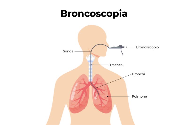 Illustrazione della procedura diagnostica della broncoscopia con sonda e broncoscopio che vengono calati tramite canale orale verso trachea e bronchi