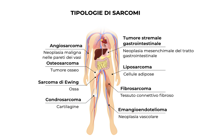 Illustrazione di un corpo umano con specifiche dei differenti sarcomi