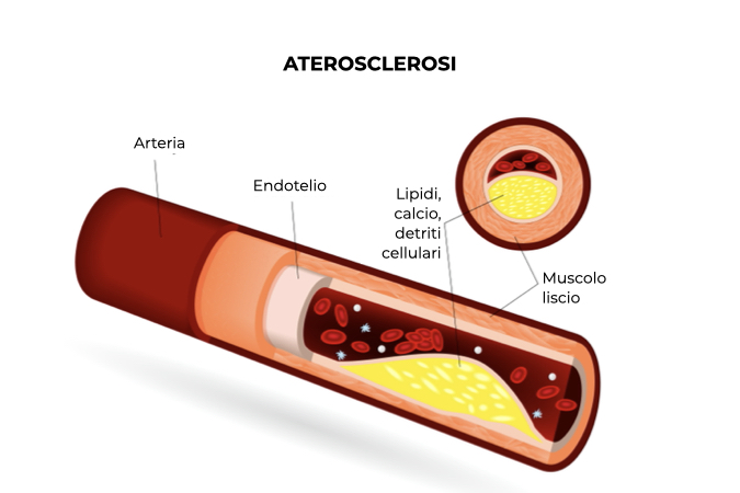 Illustrazione di una arteria con placche arteriosclerotiche