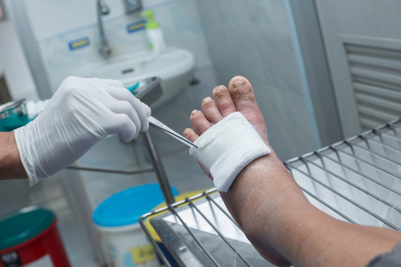 Primo piano di un piede sinistro di un paziente mentre un infermiere utilizza una garza per trattare le ulcere del piede diabetico