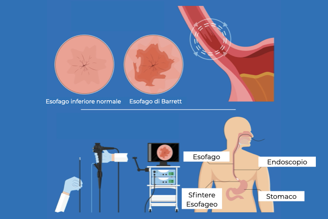 Illustrazione del corpo di un uomo con esofago di Barrett e endoscopio usato per diagnosticare questa patologia