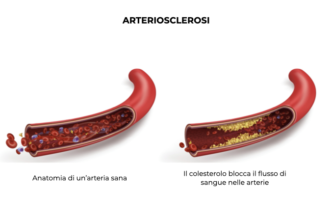 Illustrazione di un'arteria sana e un'arteria con colesterolo che blocca il flusso sanguigno causando l'arteriosclerosi