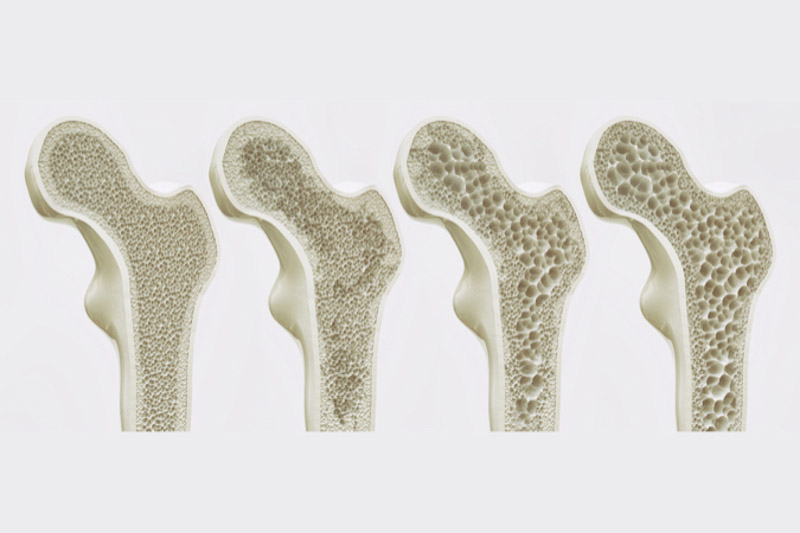Immagine di 4 ossa con le diverse fasi di osteoporosi
