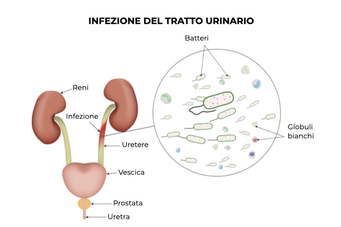 Illustrazione del tratto urinario infettato dai batteri