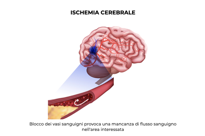 Illustrazione dei vasi sanguigni del cervello bloccati causano ischemia cerebrale