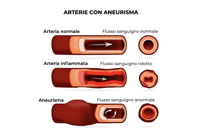 Illustrazione di tre arterie: normale, infiammata e con aneurisma