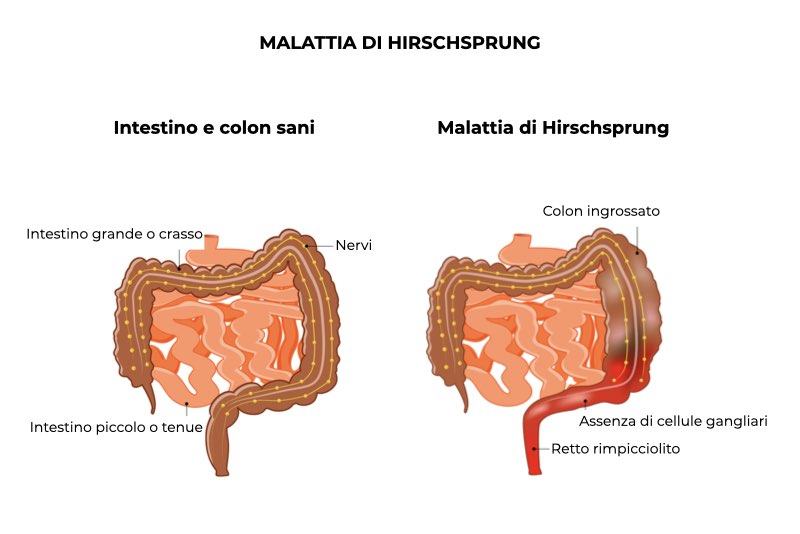 Illustrazione di un intestino sano a confronto con un intestino con malattia di Hirschsprung