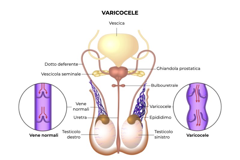Illustrazione dell'organo genitale maschile con testicolo destro sano e testicolo sinistro con varicocele