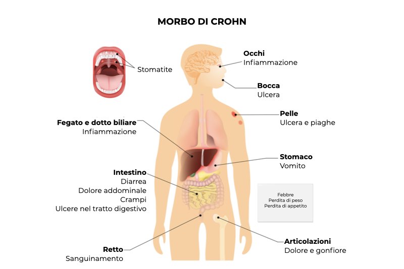 Illustrazione dei sintomi derivanti dal Morbo di Crohn