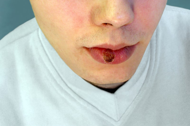 Primo piano delle labbra di un ragazzo con la sifilide