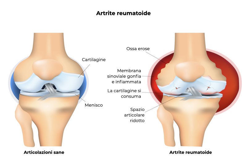 Illustrazione di due ossa sana e con artrite reumatoide