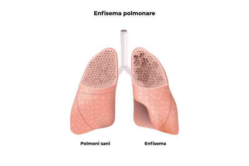 Illustrazione che mostra come si presenta l'enfisema polmonare
