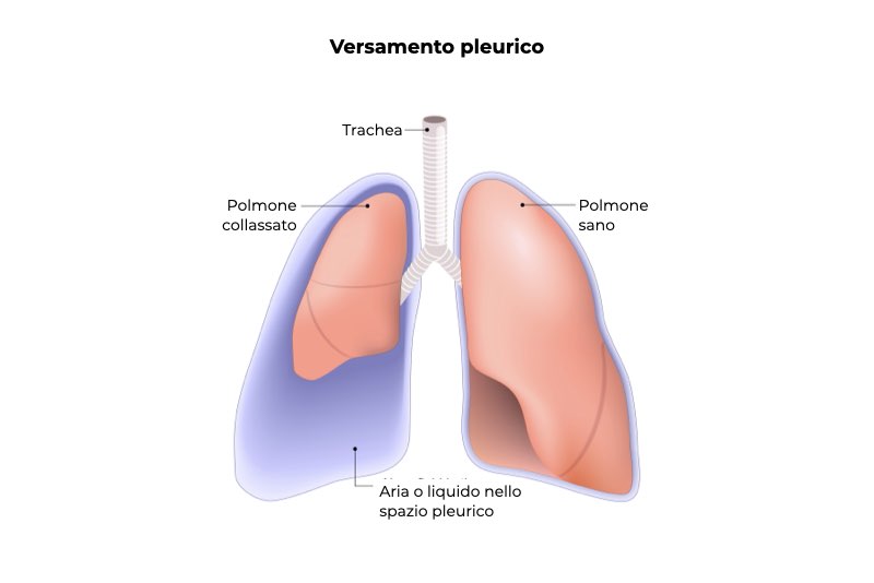 Illustrazione di un polmone con versamento pleurico