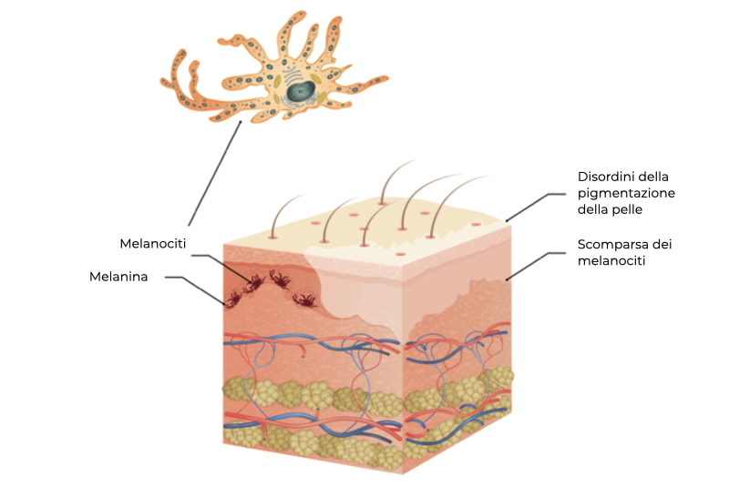 Presenza dei melanociti normali nella pelle e area depigmentata con assenza di melanociti in soggetto con vitiligine