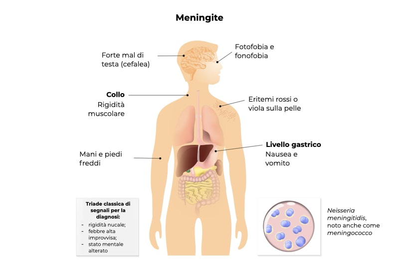 Sintomi ed effetti della meningite batterica, con focus sul batterio del meningococco, a livello di cefalea, fotofobia, fonofobia, rigidità muscolare, vomito, nausea