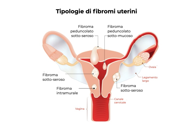 Illustrazione di un utero che presenta varie forme di fibromi uterini: sotto-serosi, sotto-mucosi, peduncolati sotto-mucosi, peduncolati sotto-serosi e intramurali
