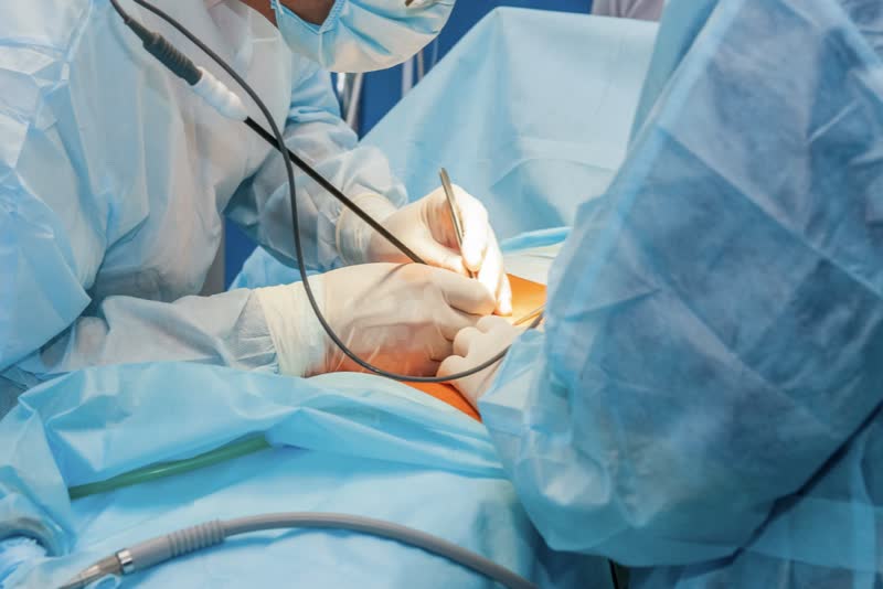 Squadra di chirurghi nel corso di un'operazione chirurgica nella zona addominale di rimozione di tessuti infetti a causa di peritonite