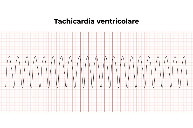 Elettrocardiogramma di soggetto affetto da tachicardia ventricolare