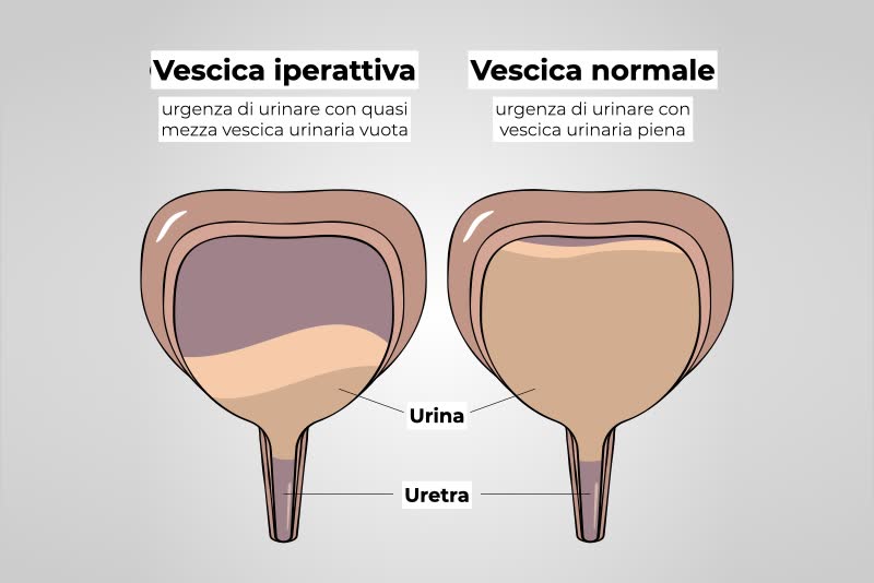 Illustrazione di due vesciche urinarie a confronto: a sinistra una vescica iperattiva, con necessità di urinare anche quando piena a metà, a destra una vescica normale, con urgenza di urinare quando piena