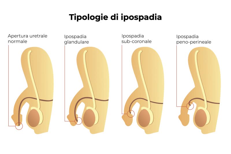Illustrazione di quattro organi genitali maschili, tre dei quali affetti da ipospadia: glandulare, sub-coronale e peno-perinale