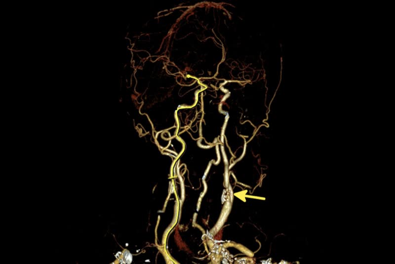 Stenosi dell'arteria carotidea (Stenosi carotidea), contrassegnata dalla freccia, rilevata grazie ad angiografia tramite tomografia computerizzata in un paziente
