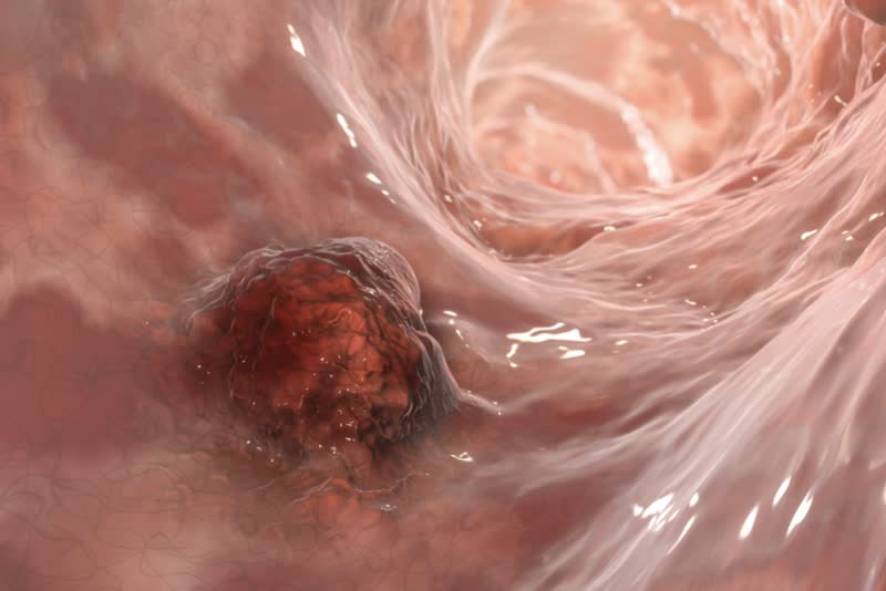 Immagine 3D rappresentativa di una massa tumorale (neoplasia) all'interno dell'intestino