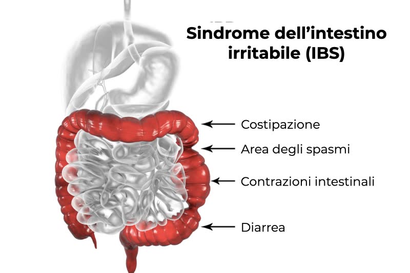 Illustrazione dell'apparato digerente e dell'intestino con i principali sintomi e conseguenze provocate dalla sindrome dell'intestino irritabile (IBS)