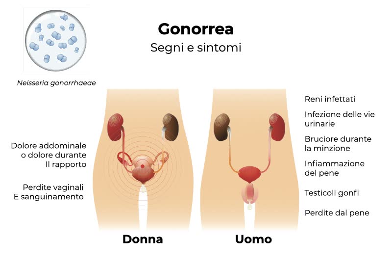 Illustrazione di genitali maschili e femminili afflitti da gonorrea con sintomi e segni contraddistintivi