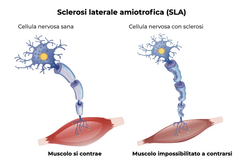 Illustrazione grafica di una cellula nervosa sana e una cellula nervosa affetta da sclerosi laterale amiotrofica (SLA) che rende impossibile la contrazione dei muscoli