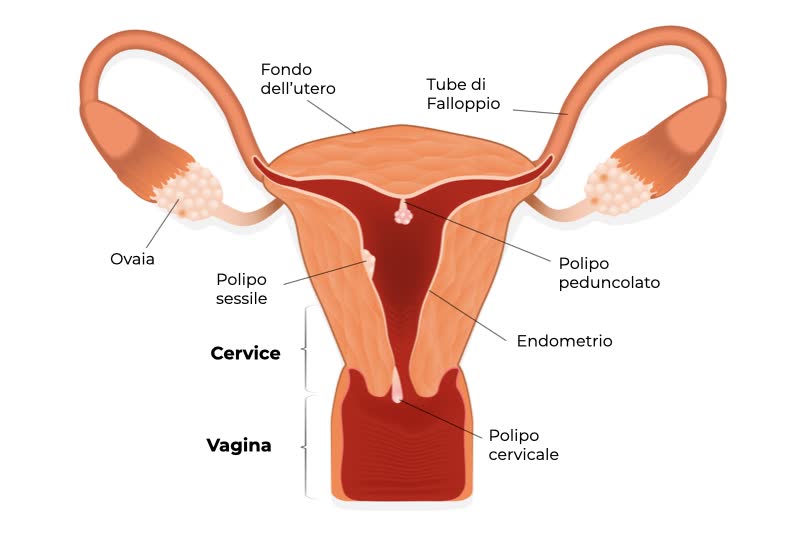 Immagine 3d di un utero affetto da varie forme di polipi uterini, da quelli sessili, a peduncolati, fino a polipi cervicali