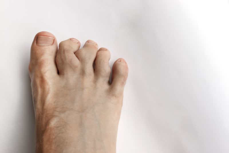 Primo piano su piede deformato con ingrossamento delle dita e delle ossa delle dita causato da condroma