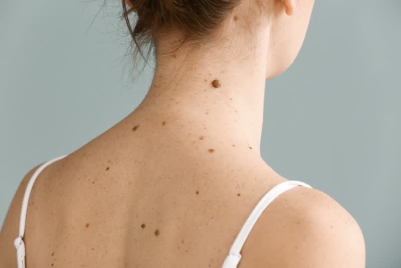 Donna giovane bruna di spalle con schiena coperta di nei, epiteliomi e altri