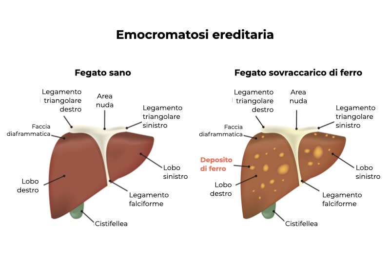 Illustrazione dell'emocromatosi ereditaria con fegato sano a sinistra e sovraccarico di ferro a destra, con focalizzazione sui depositi di ferro