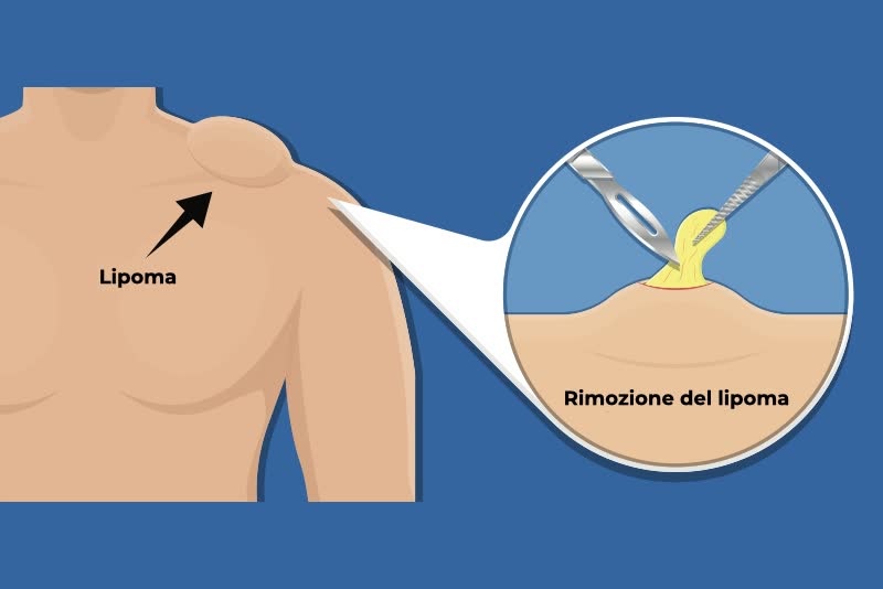 Illustrazione di un rigonfiamento (lipoma) sulla spalla di una persona con ingrandimento sull'operazione di rimozione del lipoma
