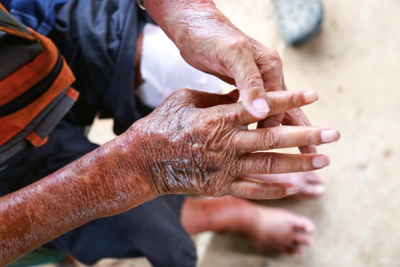 Foto del braccio di una donna con un disordine della pelle color peperone che fa riferimento alla patologia della sclerosi sistemica (sclerodermia)