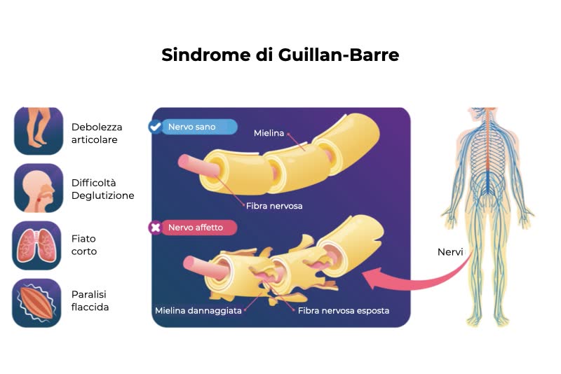 Illustrazione che spiega la sindrome di guillan barre con le sue principali sintomatologie (sintomi) e processo di demielienizzazione illustrato al centro con specchietto di un corpo umano a livello di sistema nervoso sulla destra