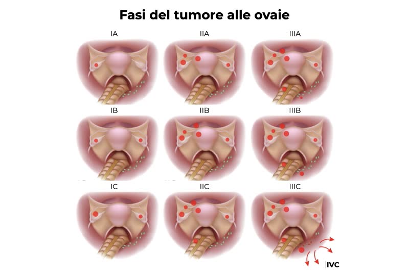 Illustrazioni con le diverse fasi di un tumore alle ovaie, a partire dal primo stadio fino allo stadio IVC