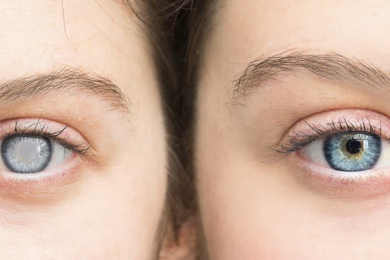 Foto di due donne con occhi da una parte sani (destra) e dall'altra affetti da cataratta (sinistra) come si nota dal tipico pallore