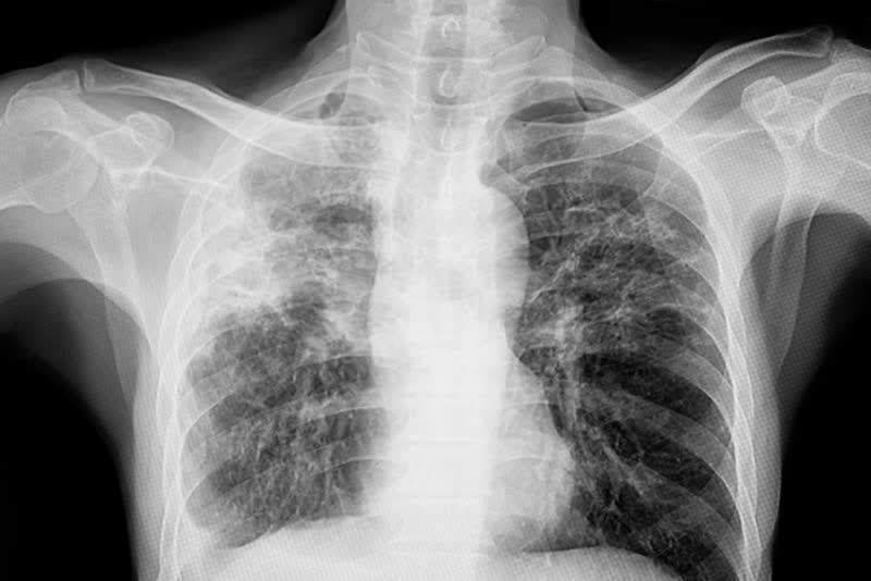 Immagine radiografica dopo RX di polmoni che mostrano una infezione da mucobacterium tubercolosis, sofferenti dunque tubercolosi