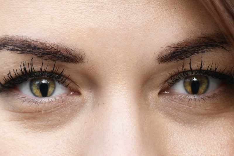 Foto di donna con occhi aperti caratterizzati dalla classica deformazione della pupilla causata da coloboma