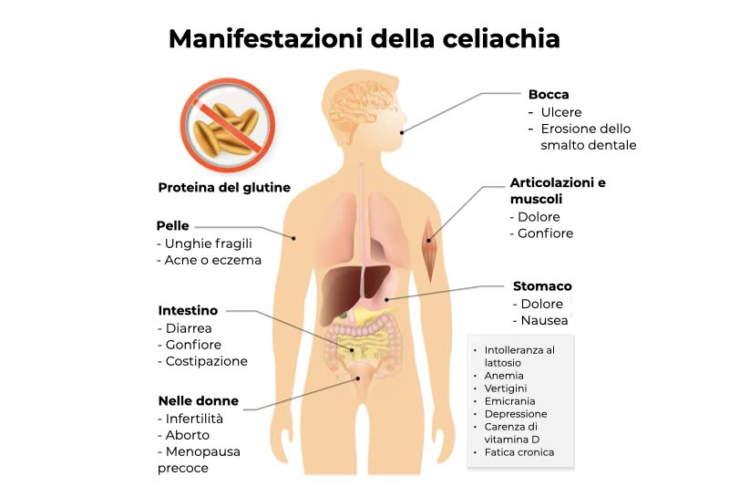 Illustrazione 3d per rappresentare la celiachia nelle sue varie manifestazioni (conseguenze) e nei sintomi che caratterizzano la sprue celiaca