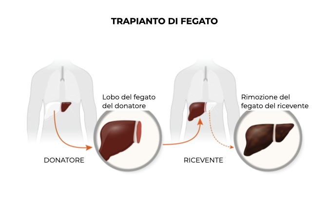 Illustrazione di come avviene il trapianto di fegato da parte di un donatore a un ricevente
