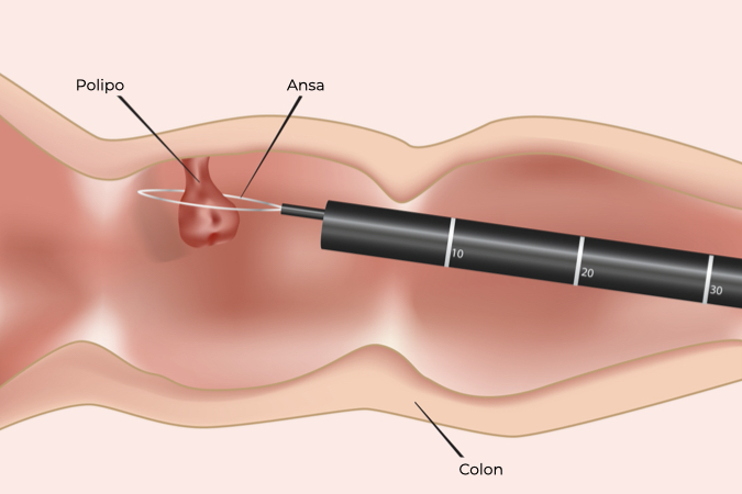 Illustrazione di intervento di polipectomia con ansa che avvolge il polipo per asportarlo
