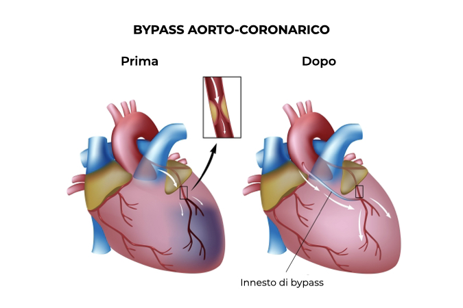 Illustrazione due cuori prima e dopo intervento di bypass aorto-coronarico